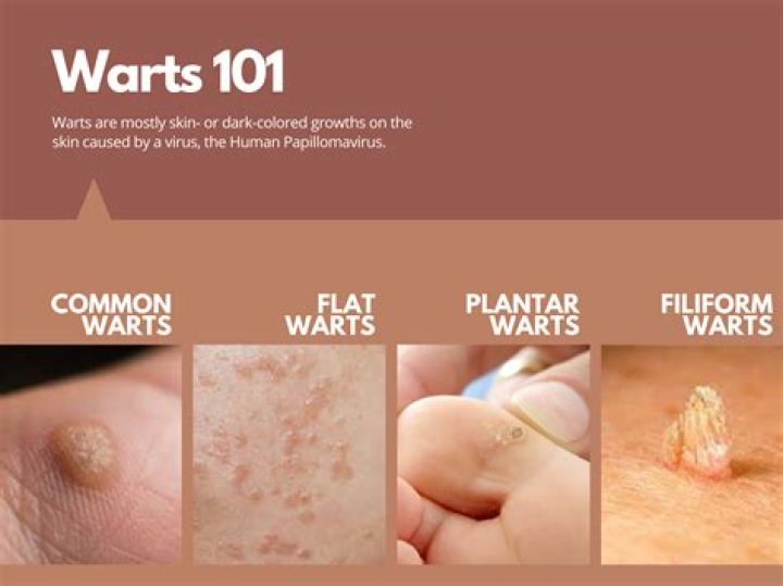Are common warts an STD?