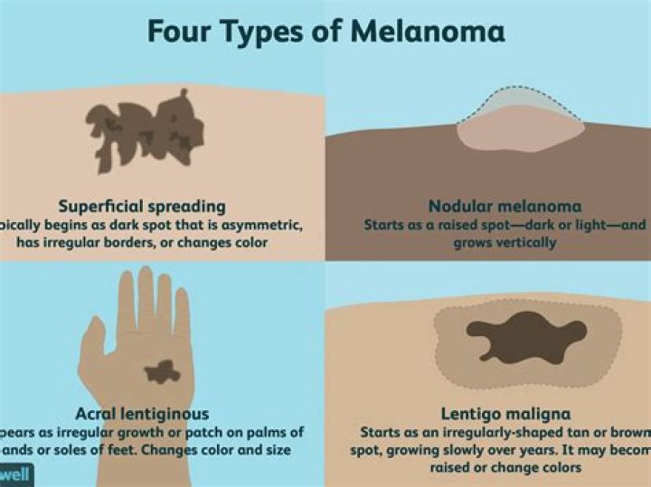 Are melanomas always black?