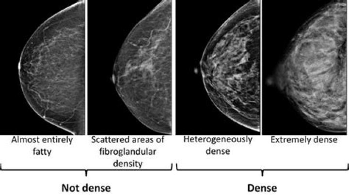 Are small breasts more likely to be dense?