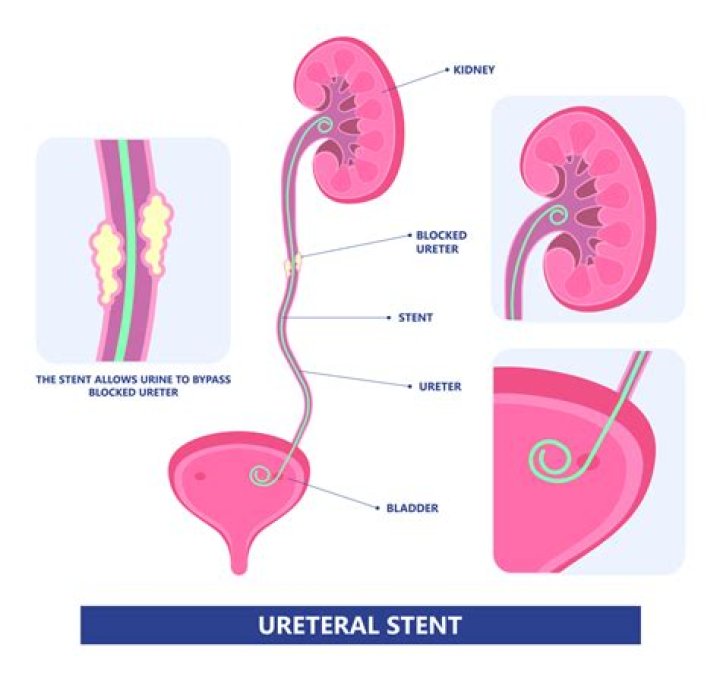 Are ureteral stents safe?