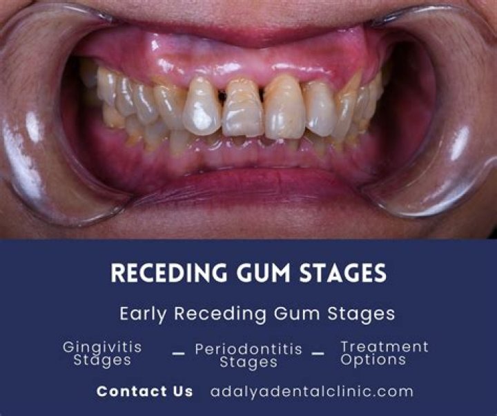 At what age do people get gum grafts?