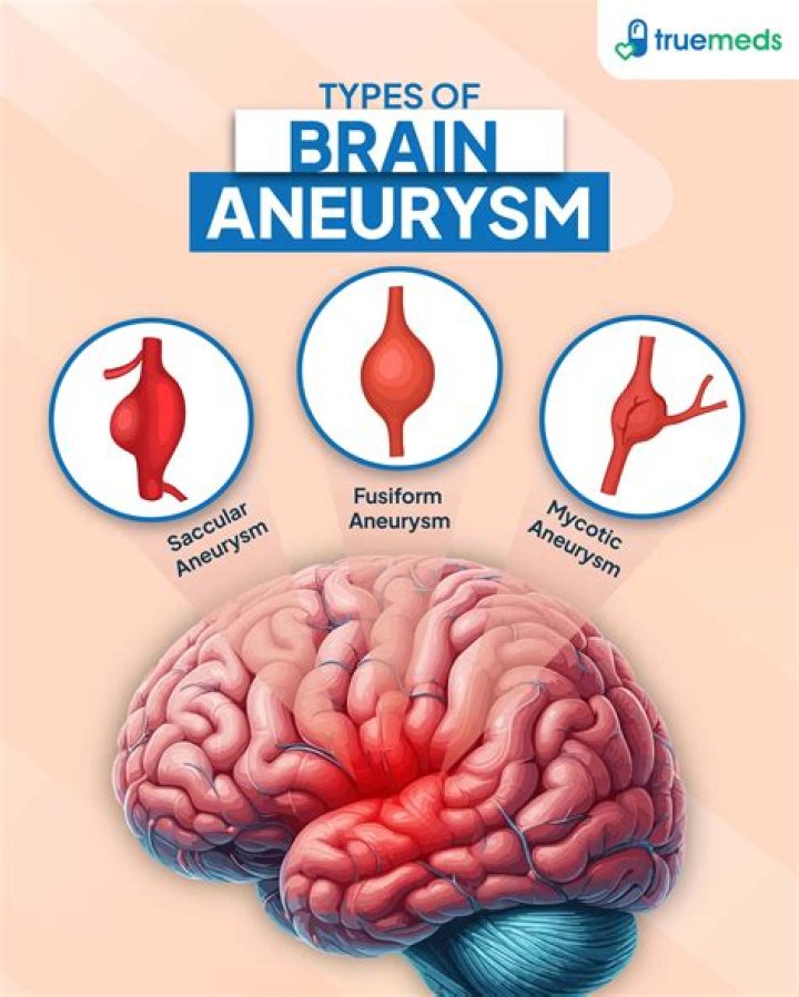Can a brain aneurysm affect your mood?