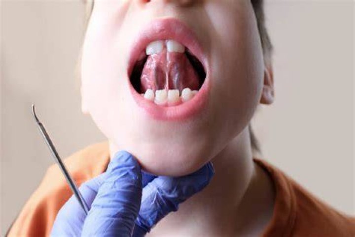 Can a dentist cut a tongue-tie?
