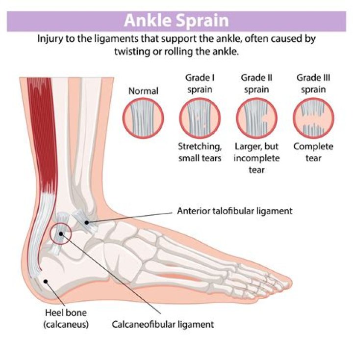 Can a grade 3 ankle sprain heal without surgery?