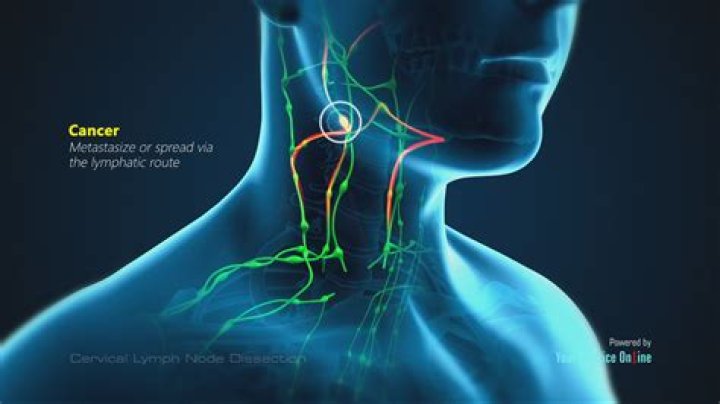 Can a hard lymph node be benign?