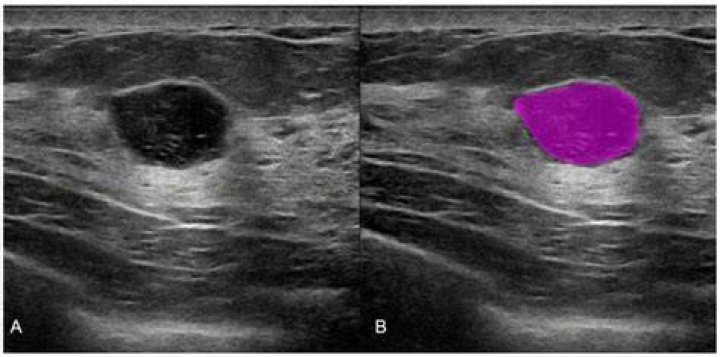 Can an ultrasound miss a tumor?