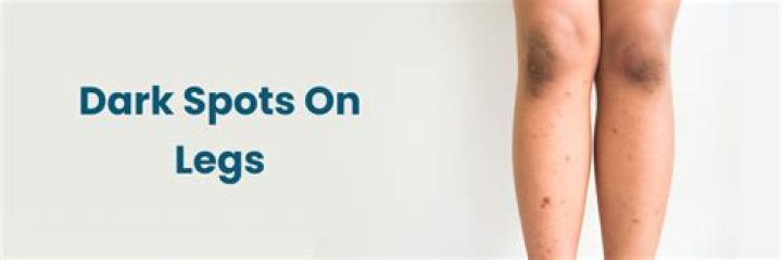 Can baking soda remove dark spots on legs?