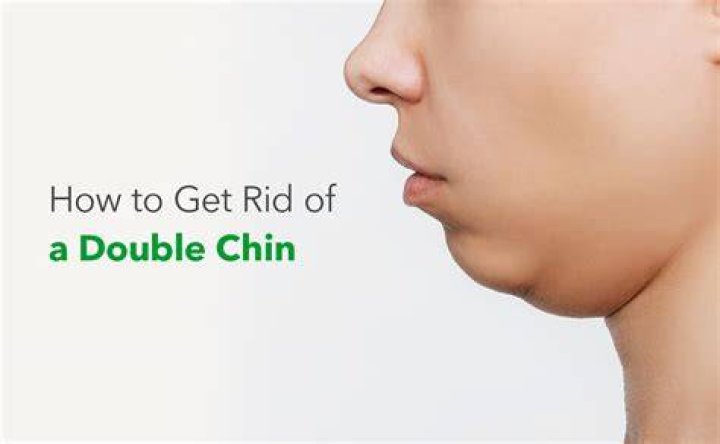 Can chin filler migrate to double chin?