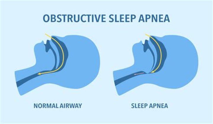 Can I lose my job because of sleep apnea?
