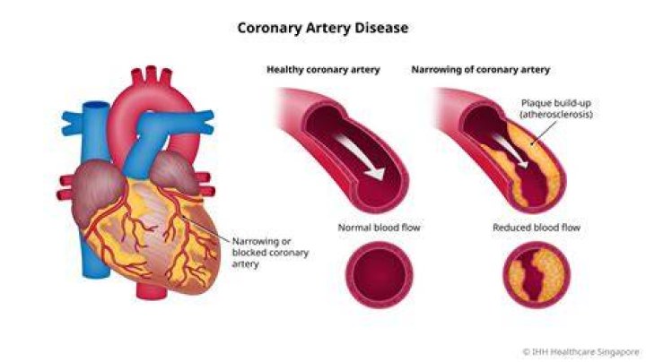 Can magnesium reverse hardening of the arteries?