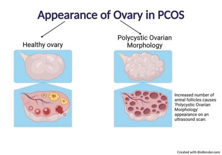 Can PCOS be pregnant?