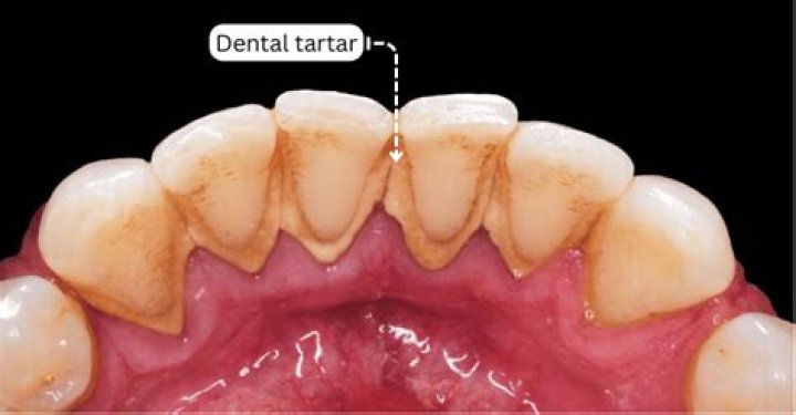 Can tartar chip off?
