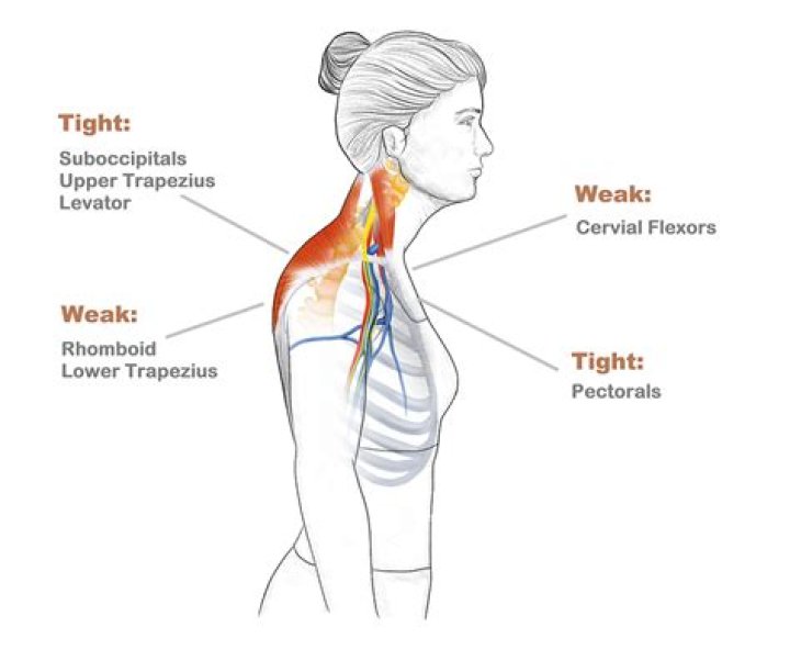 Can tight neck muscles affect blood flow to brain?