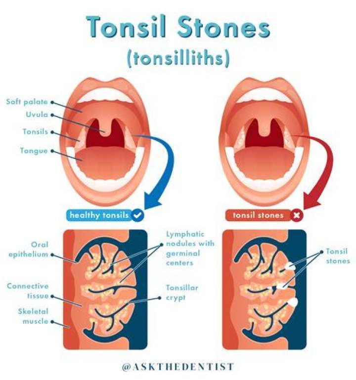 Can tonsil stones make you sick?