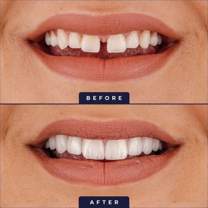 Can veneers wear down?