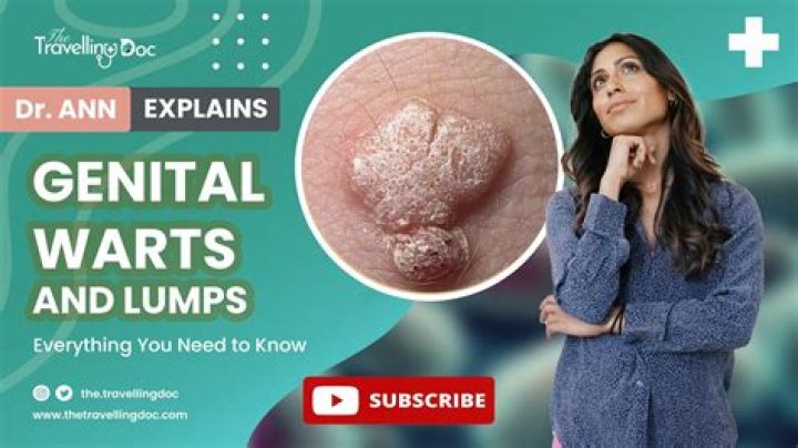 Can warts be popped?