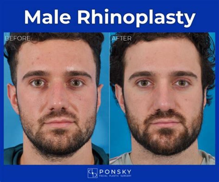 Can you do rhinoplasty during period?