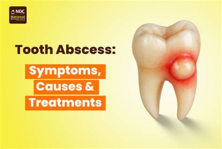 Can you drink coffee with an abscessed tooth?