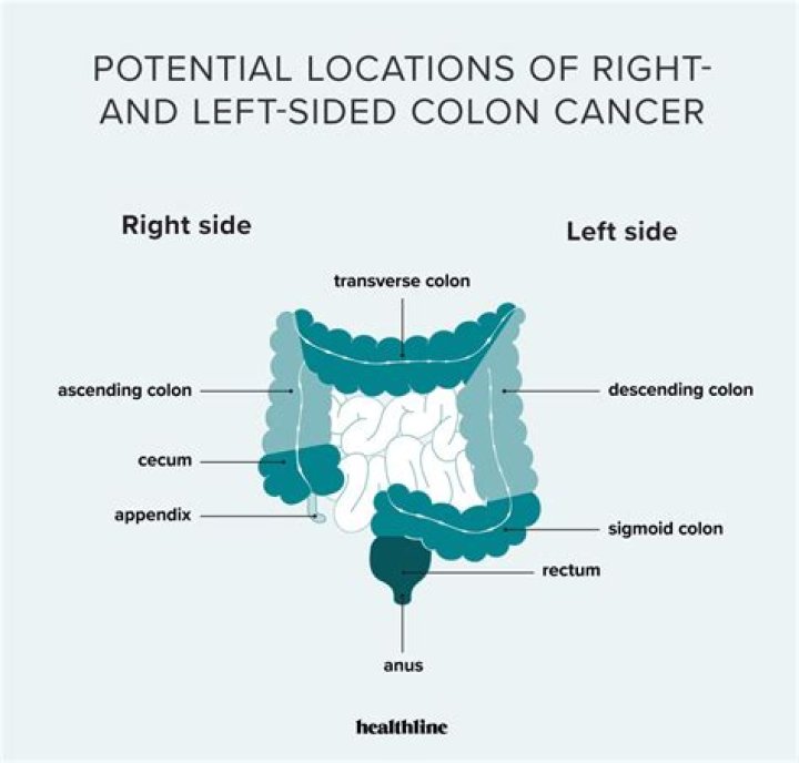Can you feel a tumor in your colon?