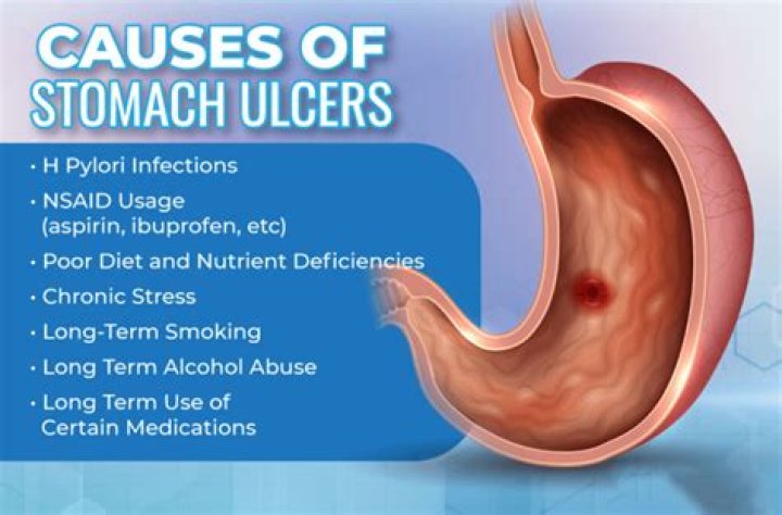 Can you get a stomach ulcer from anxiety?