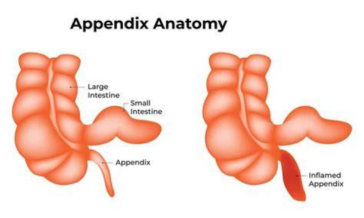 Can you have no appendix?