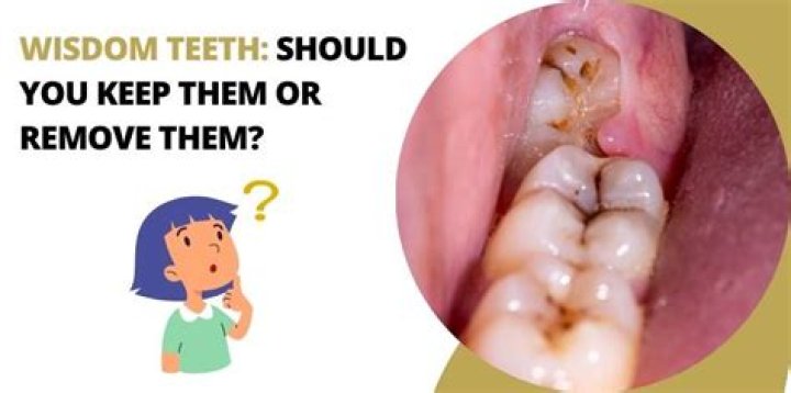 Can you live with your wisdom teeth?