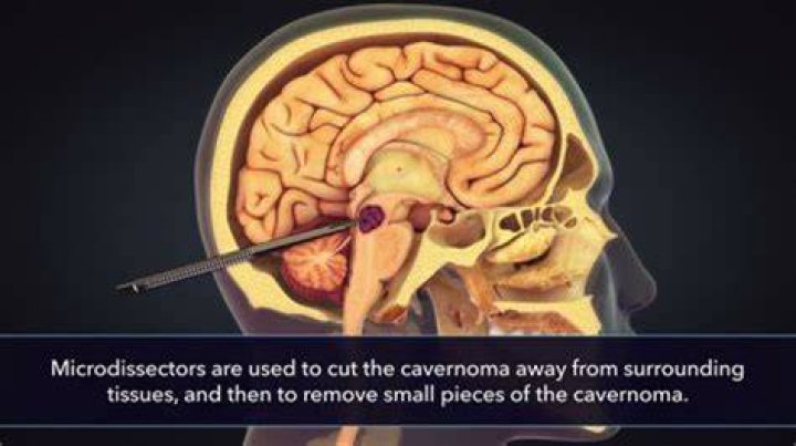 Can you see a brain tumor through the eye?