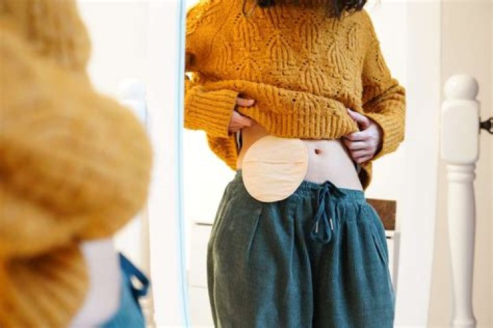 Can you wear regular clothes with a colostomy bag?