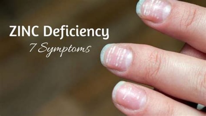 Can zinc deficiency cause warts?