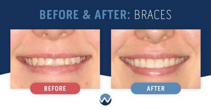 Do braces help bunions?
