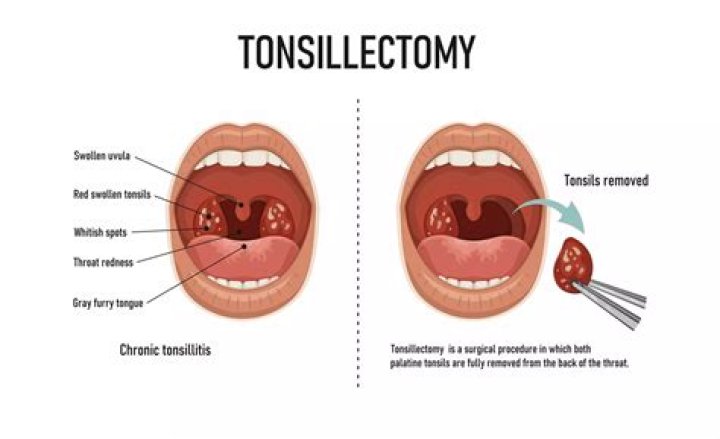Do you get stitches after tonsillectomy?