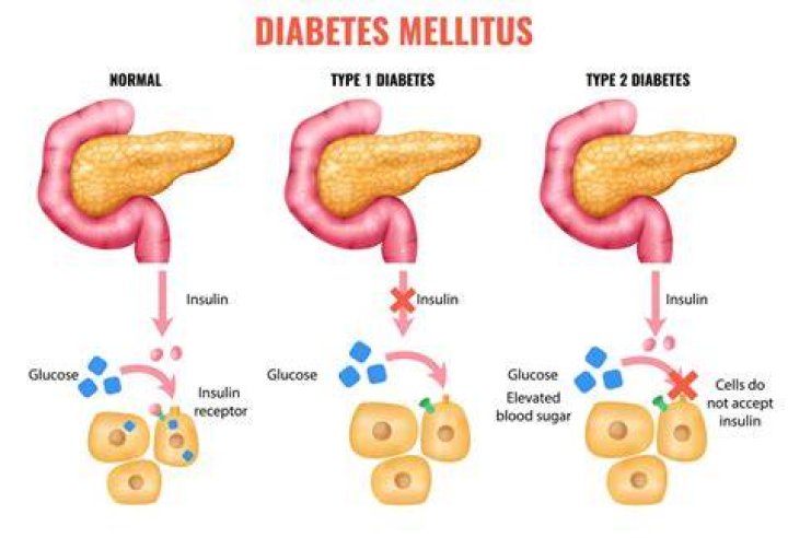 Does diabetes come from mother or father?
