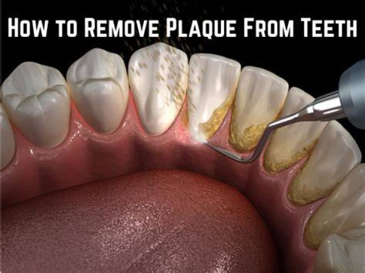 Does hydrogen peroxide get rid of plaque?