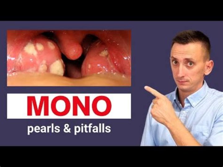 Does mono look like strep?