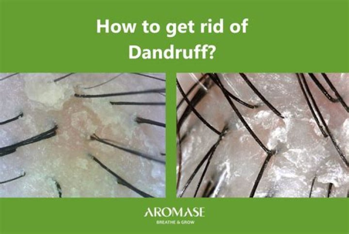 Does No Poo get rid of dandruff?