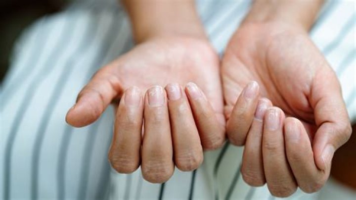 Does RA affect fingernails?