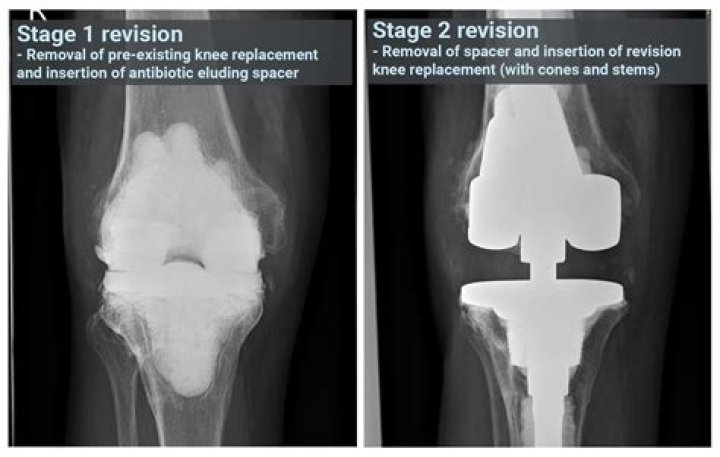 How bad is a second knee replacement?
