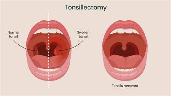 How big is too big tonsils?