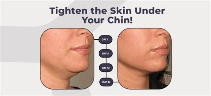 How can I tighten my sagging chin?