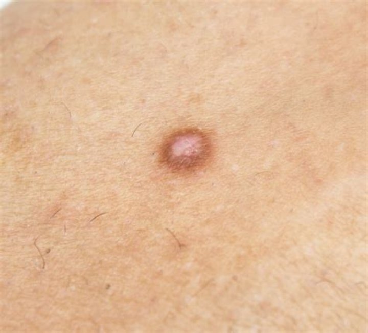 How do I get rid of dermatofibroma?