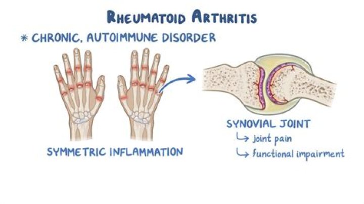 How do you comfort someone with rheumatoid arthritis?