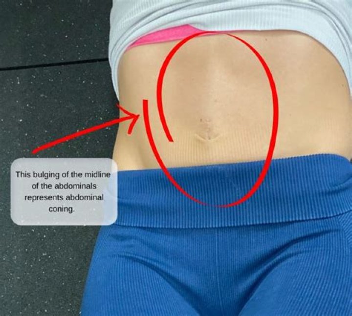 How do you fix separated stomach muscles?