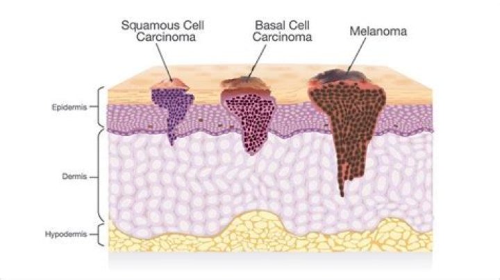 How do you know if your squamous cell carcinoma has spread?