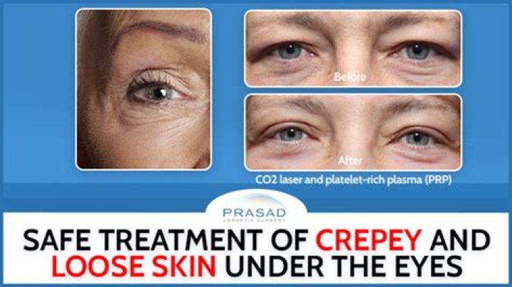 How do you plump up Crepey skin?
