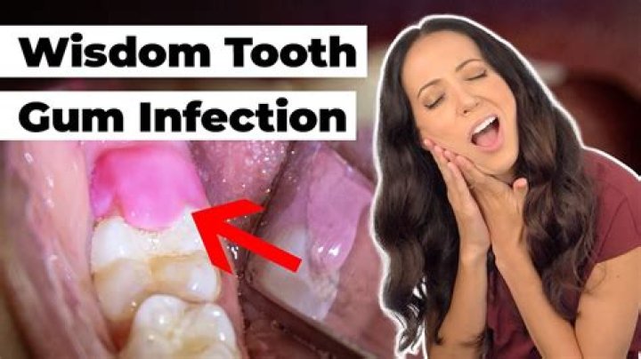 How do you tell if a gum flap is infected?