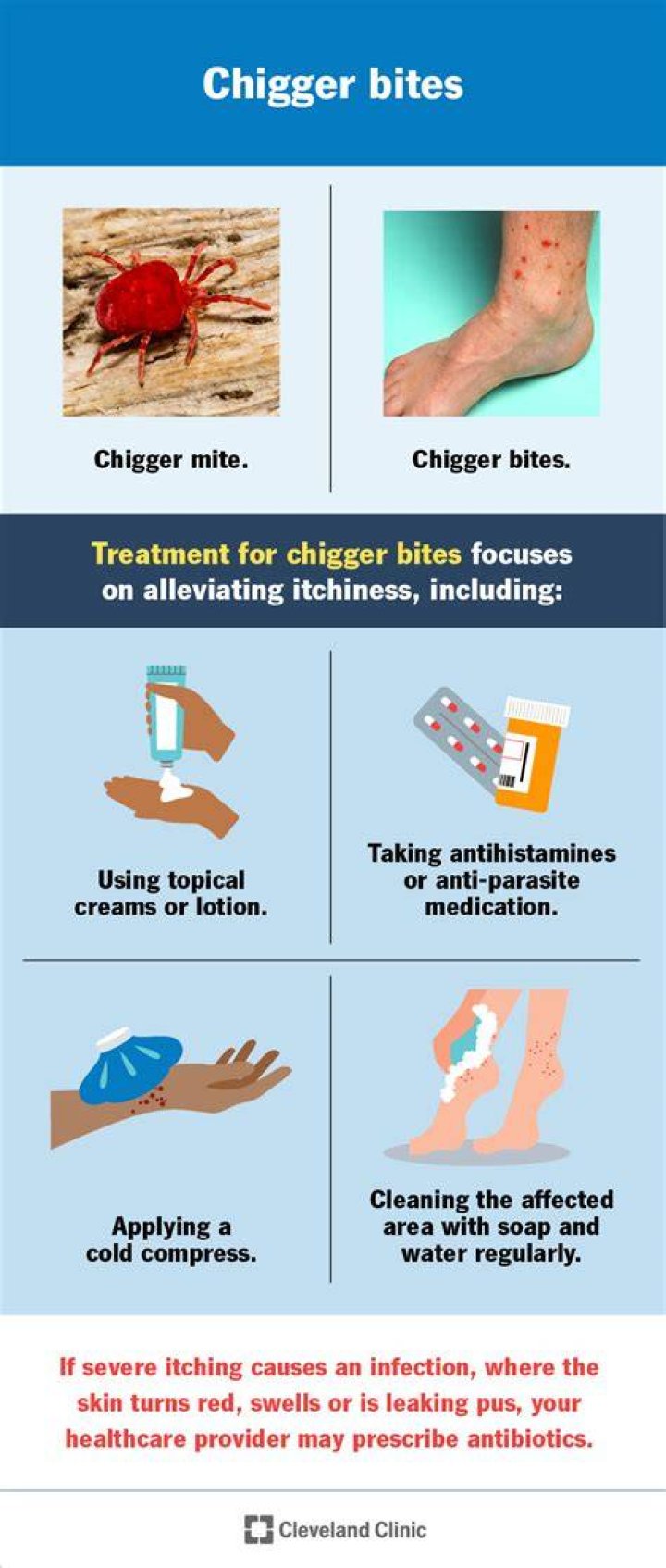 How do you tell if you have chiggers in your bed?