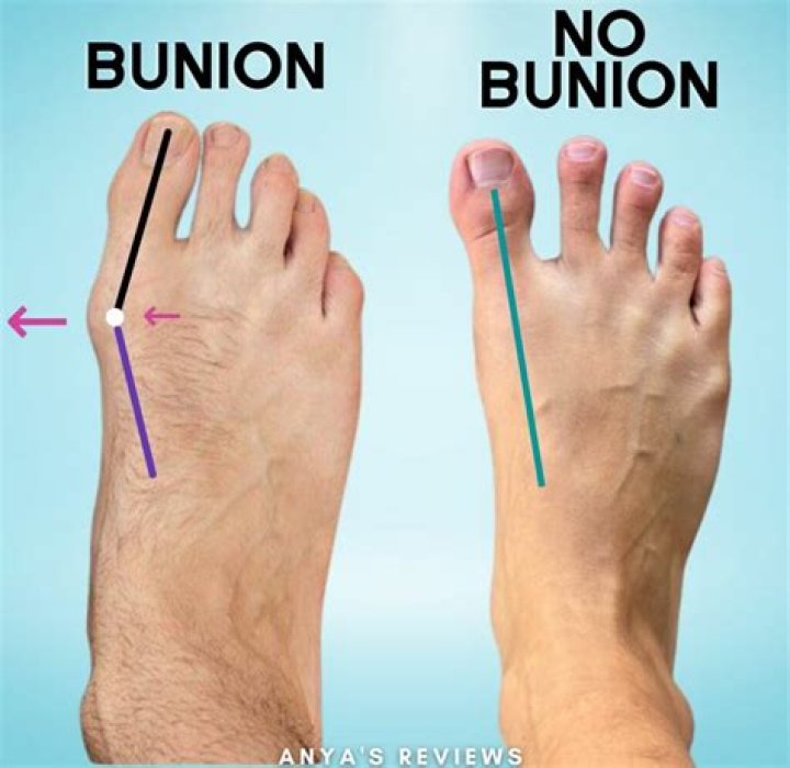 How long after bunion surgery can I wear flip-flops?