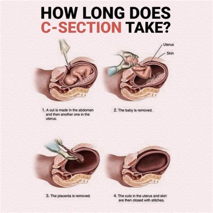 How long does a 2nd C-section take?