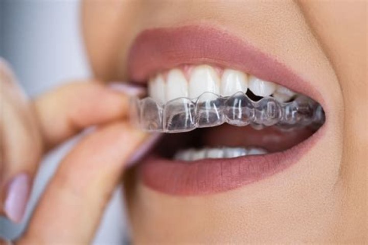 How long should you wear retainers after braces?