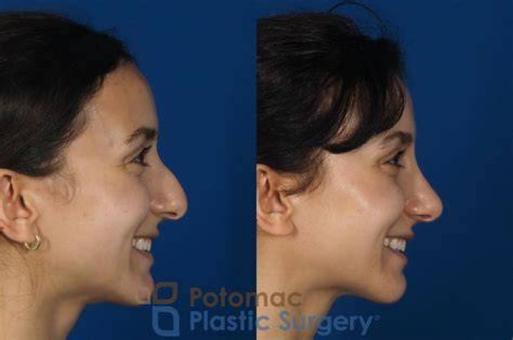 How many rhinoplasties can you have?